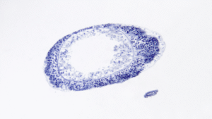 síntomas ovarios poliquísticos