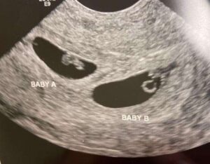 Embriones congelados por 30 años | Anacer