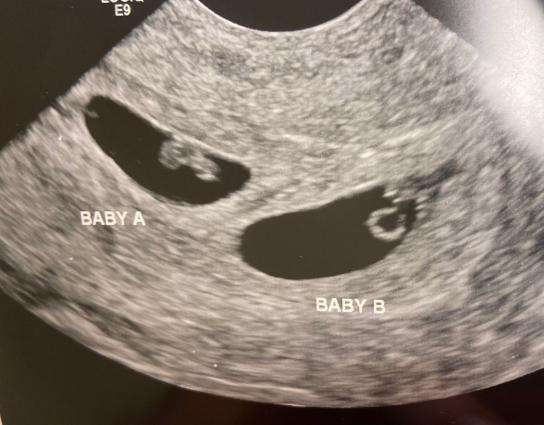 Embriones congelados por 30 años | Anacer